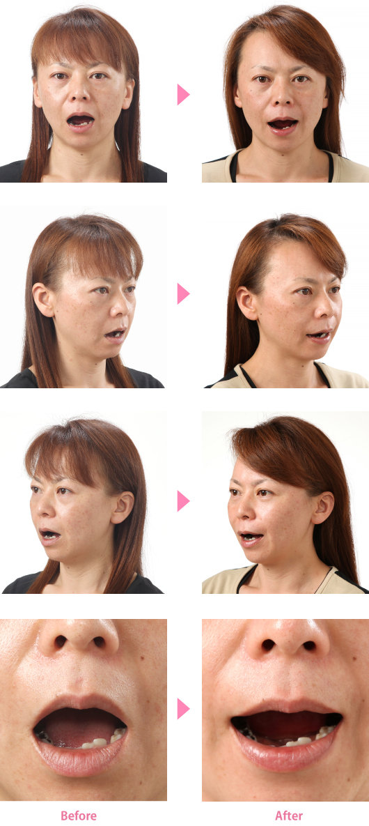 口角2_8枚縦写真
